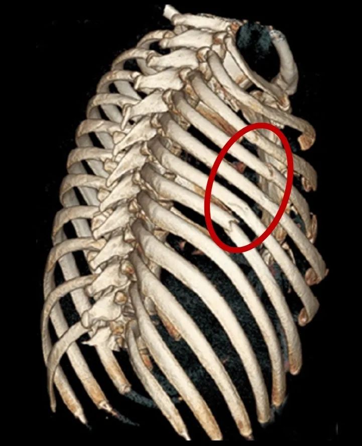 三维重建ct图,红圈中可见右侧第3~7肋骨的骨折.