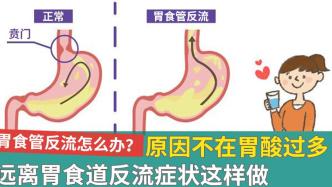 预防巴瑞特食管与食管癌，需从调理胃食管反流做起