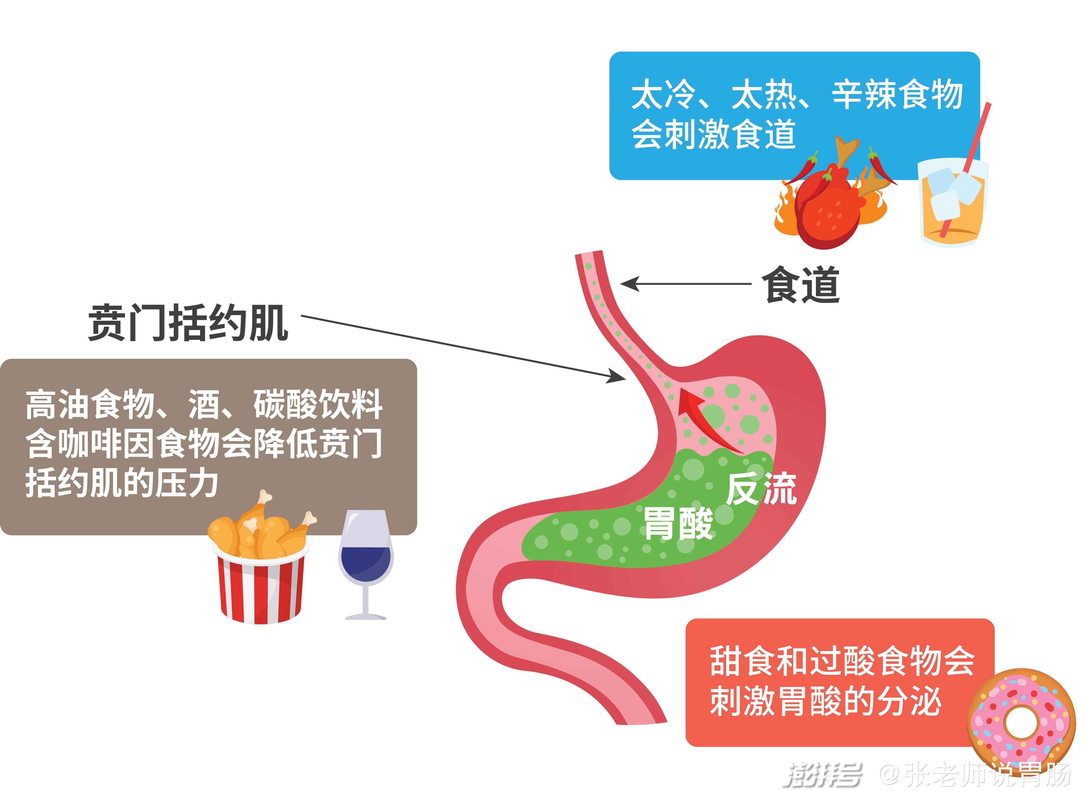预防巴瑞特食管与食管癌需从调理胃食管反流做起