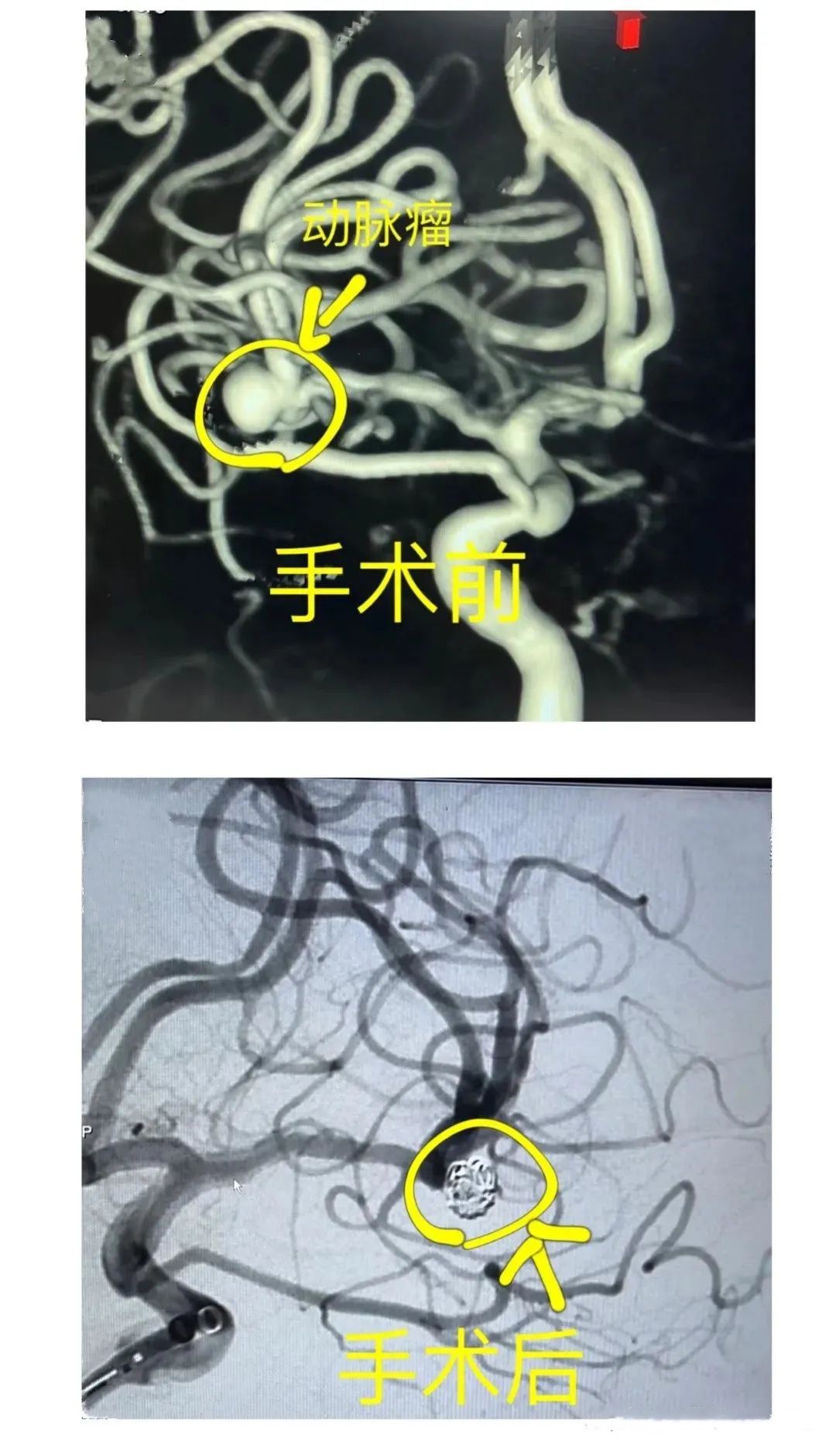 神经外科专家巧拆弹】北流市人民医院成功开展多例颅内动脉瘤栓塞术