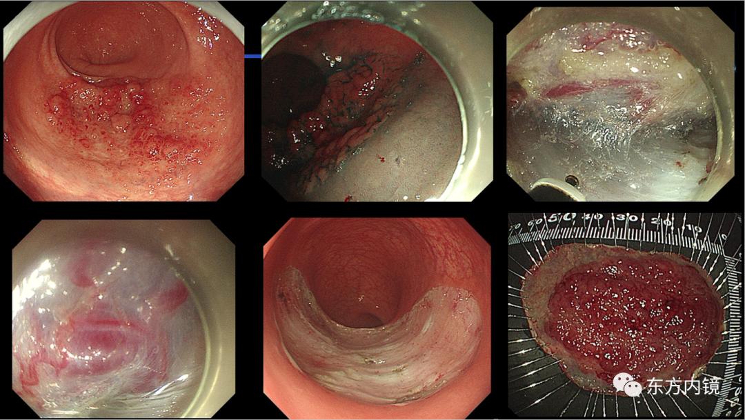 一例肠息肉在内镜医生眼中如何解析