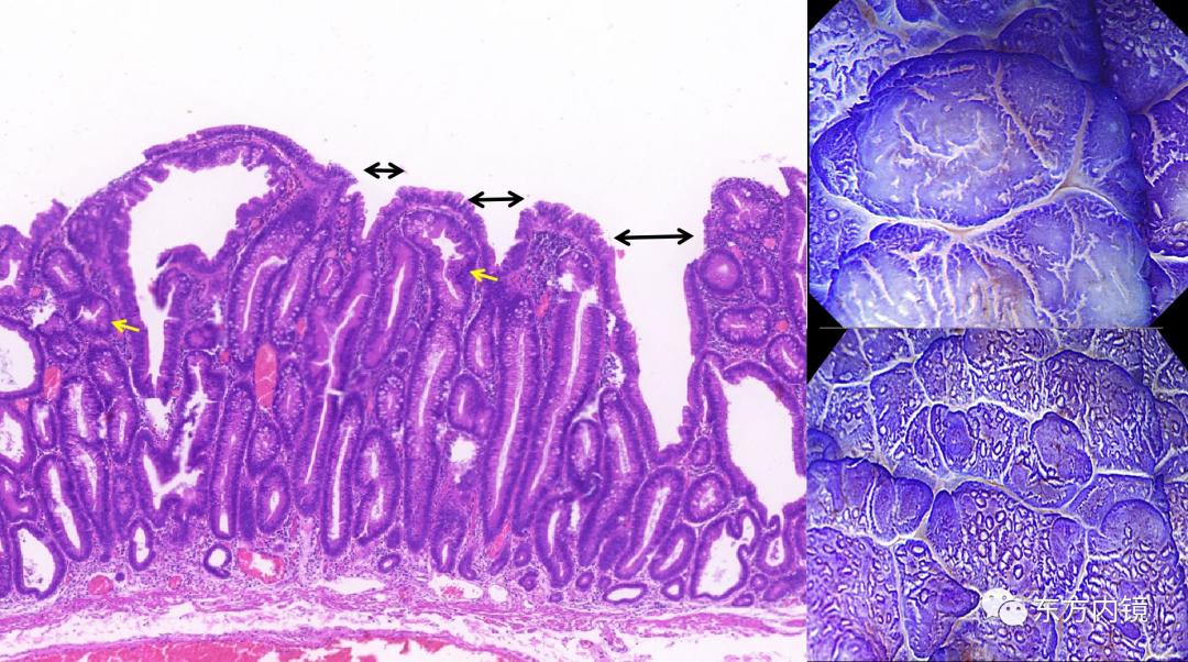 肠息肉 肠镜图片
