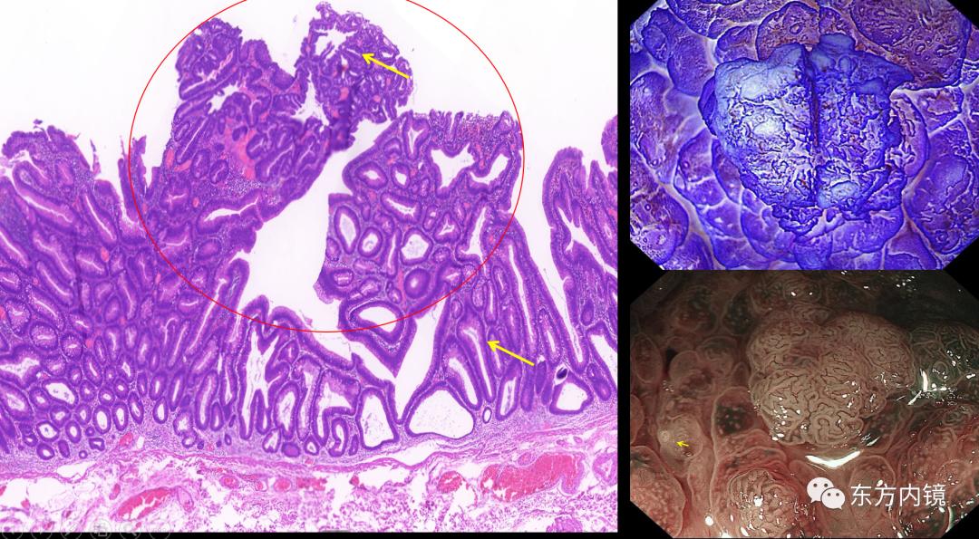 一例腸息肉在內鏡醫生眼中如何解析