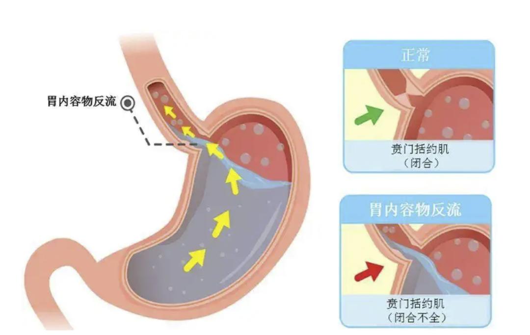 胃食管反流导致嗓子疼该怎么办