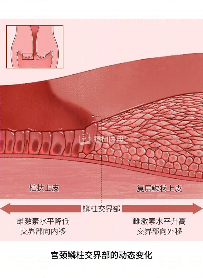 鳞柱交界可见图片