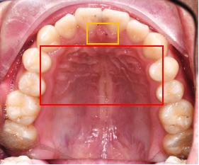 带您认识那些经常被误解成肿瘤的口腔正常组织结构