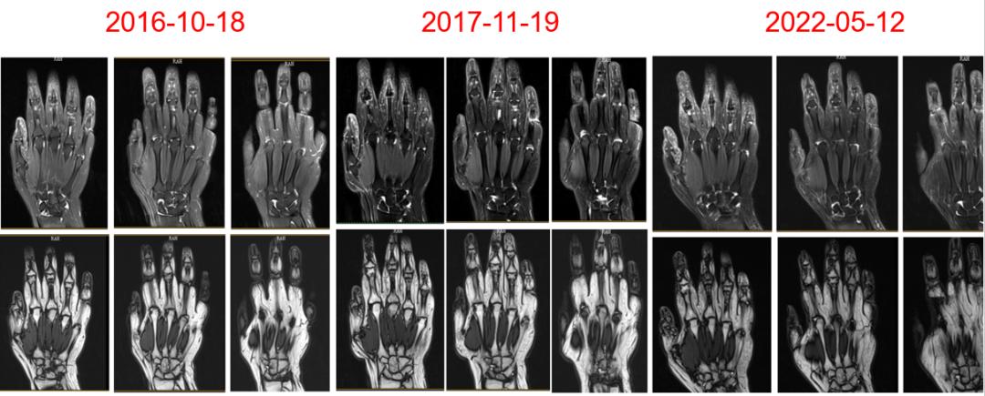 手指呈典型天鹅颈样改变最终诊断竟不是ra