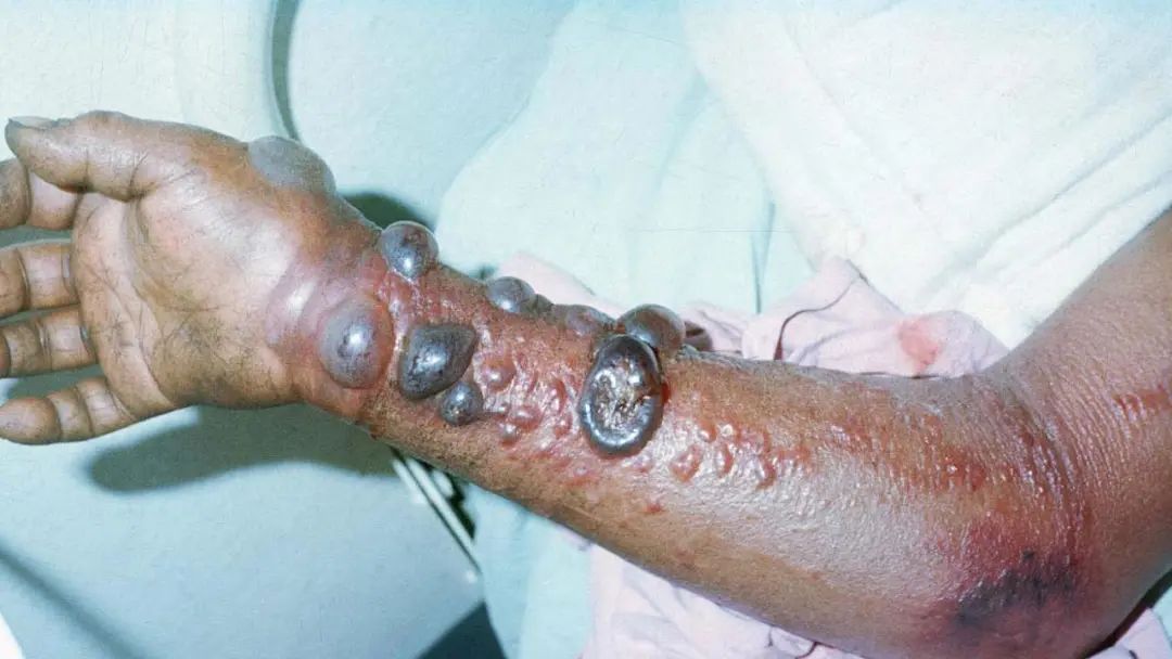 马尔堡病毒感染者图片图片