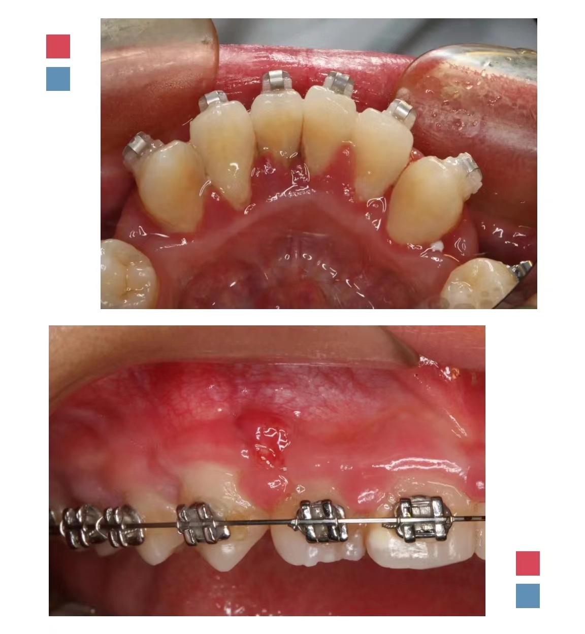 牙周病患者可以正畸吗