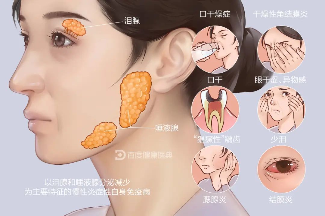 干燥综合症10大表现图片