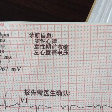 心电图电压高图片