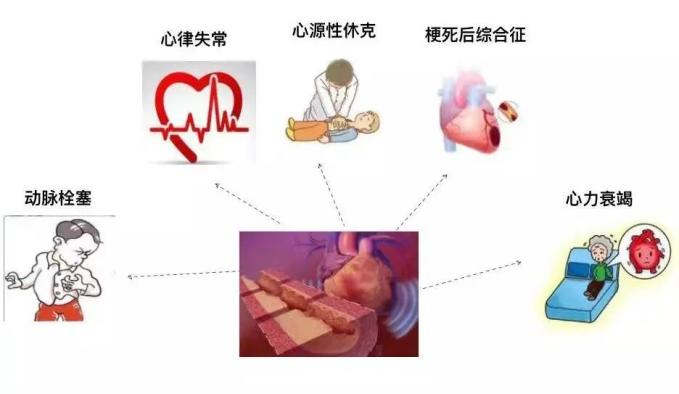 19岁男生运动后猛喝冷饮心梗去世？夏天，我们如何预防心梗的发生