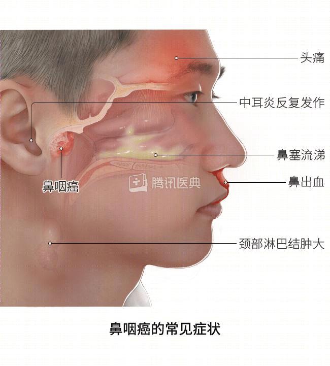 亲戚里有鼻咽癌病例,或有相关高危行为的小伙伴,出现这些症状时,建议