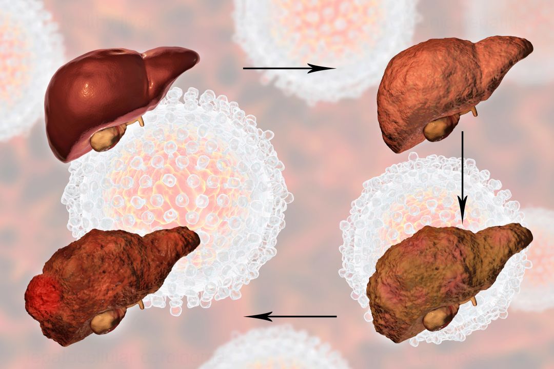 世界肝炎日乙肝可防可治早筛早诊保护好你的小心肝