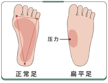 扁平足图片判断图片