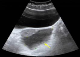 妇科蛋白膜怎么用这种妇科肿瘤无特异性，复发率高，有这些症状的姐妹小心_https://www.jmylbn.com_新闻资讯_第1张