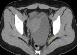 妇科蛋白膜怎么用这种妇科肿瘤无特异性，复发率高，有这些症状的姐妹小心_https://www.jmylbn.com_新闻资讯_第2张