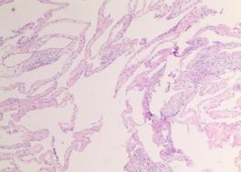 妇科蛋白膜怎么用这种妇科肿瘤无特异性，复发率高，有这些症状的姐妹小心_https://www.jmylbn.com_新闻资讯_第3张