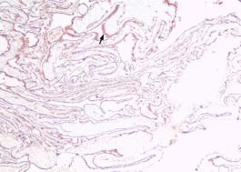 妇科蛋白膜怎么用这种妇科肿瘤无特异性，复发率高，有这些症状的姐妹小心_https://www.jmylbn.com_新闻资讯_第4张