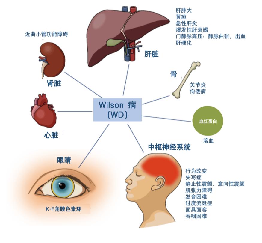 青春检验站关注肝豆病关爱铜娃娃