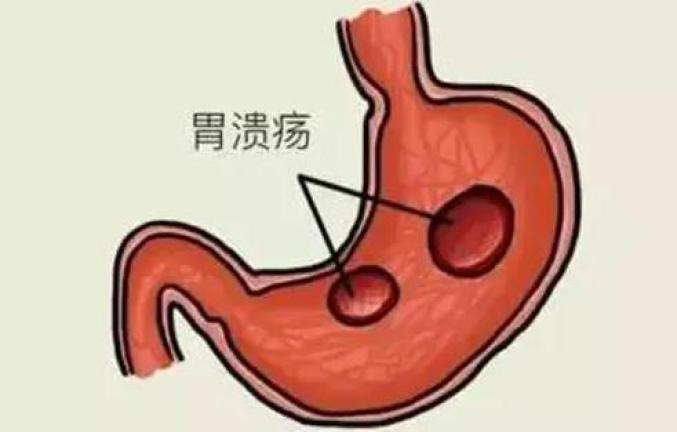 慢性胃炎胃溃疡怎么办
