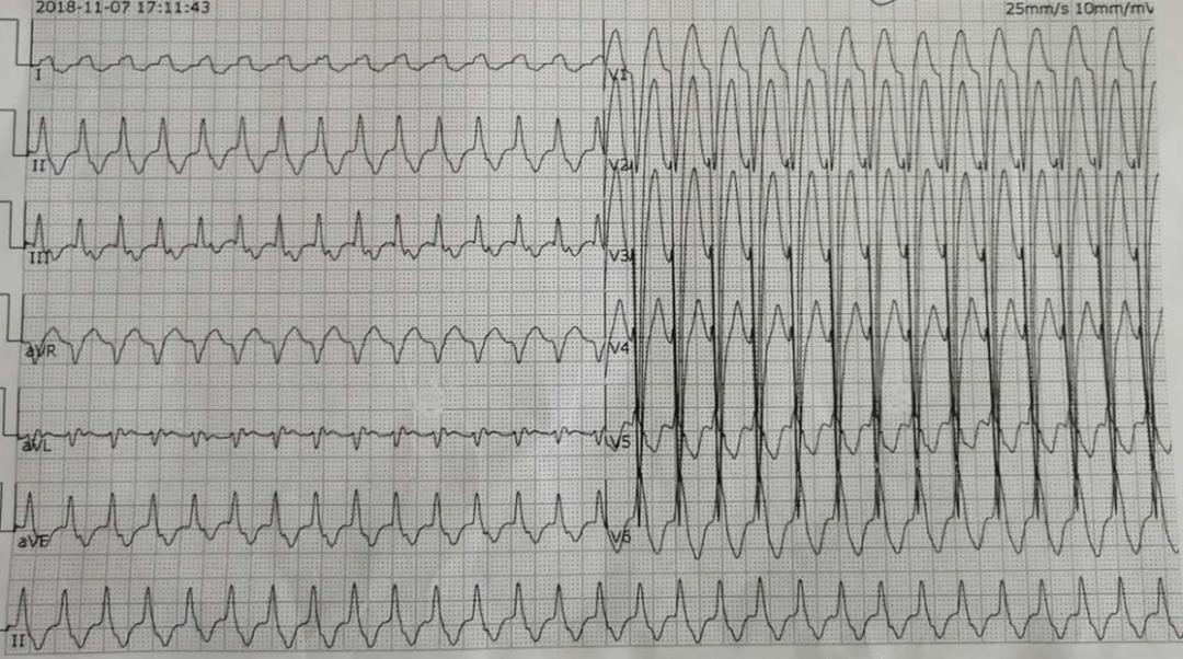 十分幸运的是,患者在入我院时心动过速发作,我们成功记录到了心电图