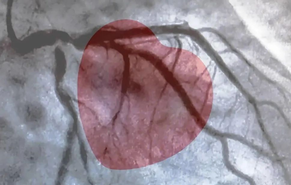 心脏是怎么固定的男子心肌梗死，检查血管没有狭窄，没有闭塞_https://www.jmylbn.com_新闻资讯_第1张