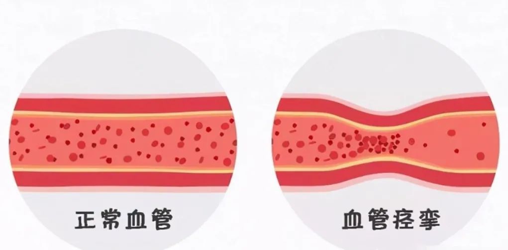 心脏是怎么固定的男子心肌梗死，检查血管没有狭窄，没有闭塞_https://www.jmylbn.com_新闻资讯_第2张