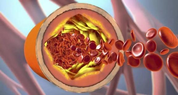 心脏是怎么固定的男子心肌梗死，检查血管没有狭窄，没有闭塞_https://www.jmylbn.com_新闻资讯_第4张