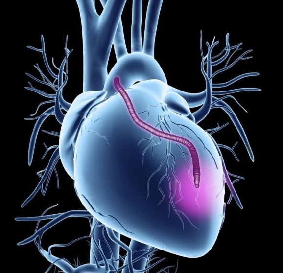 心脏是怎么固定的男子心肌梗死，检查血管没有狭窄，没有闭塞_https://www.jmylbn.com_新闻资讯_第6张