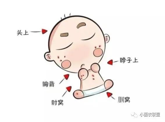 高温袭来宝宝起痱子怎么办