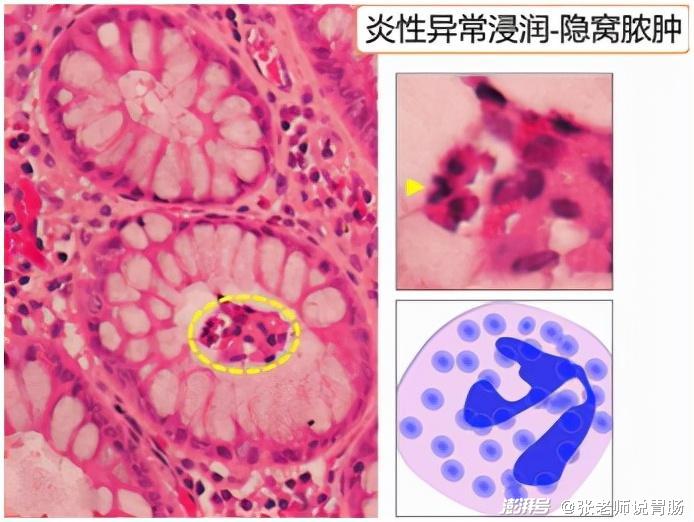 经常拉肚子不舒服?这可能也是溃疡性结肠炎在作怪,别大意