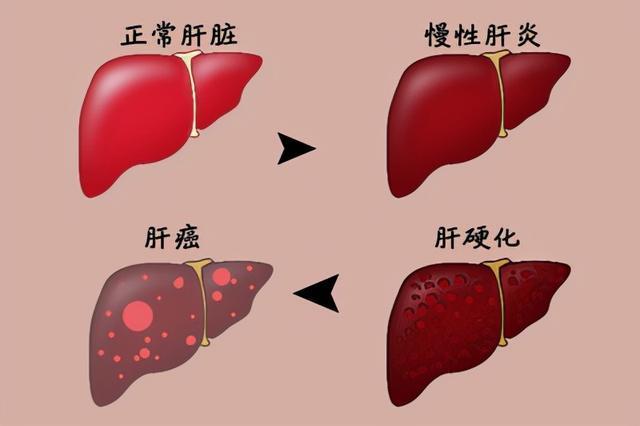 乙肝和正常人的肝图片图片