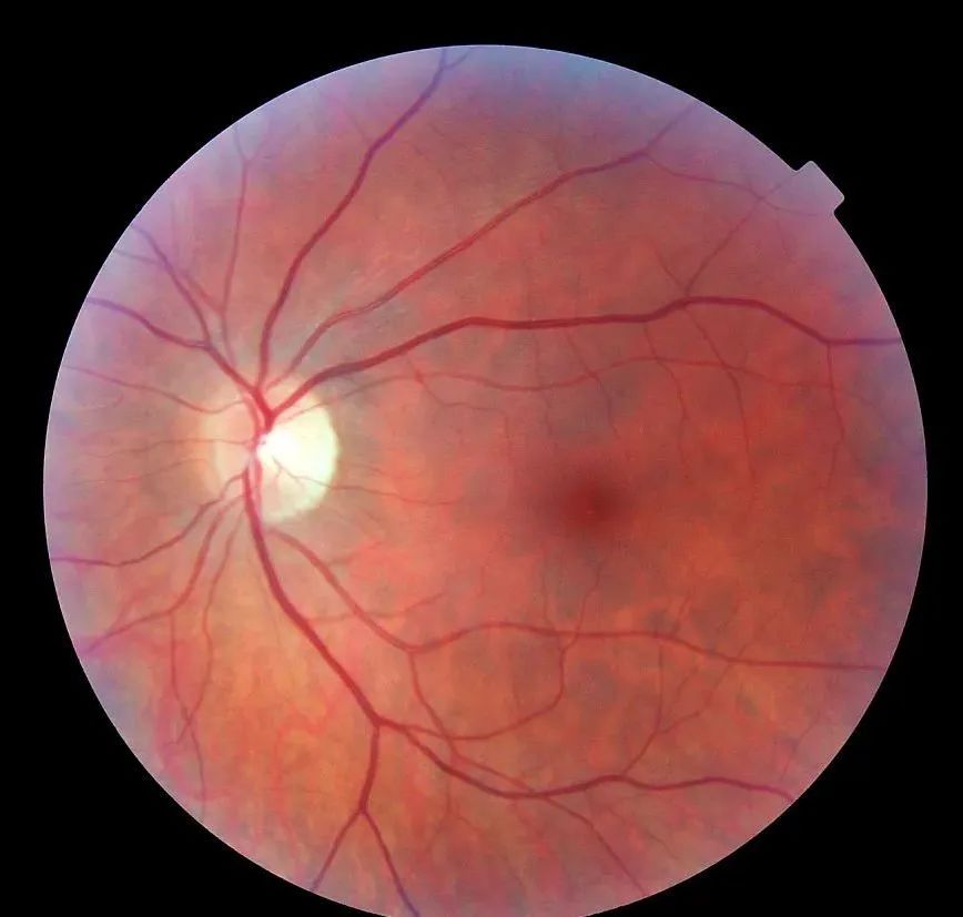 视网膜脱离一般分为原发性和继发性,原发性为孔源性视网膜脱离,继发性