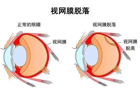 血的患者,出血后造成机化条索反复牵拉视网膜造成牵拉性视网膜脱离