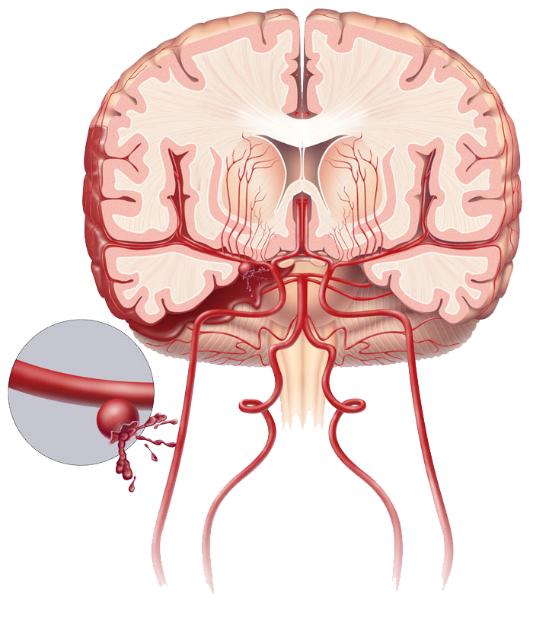 颅内动脉瘤示意图图片