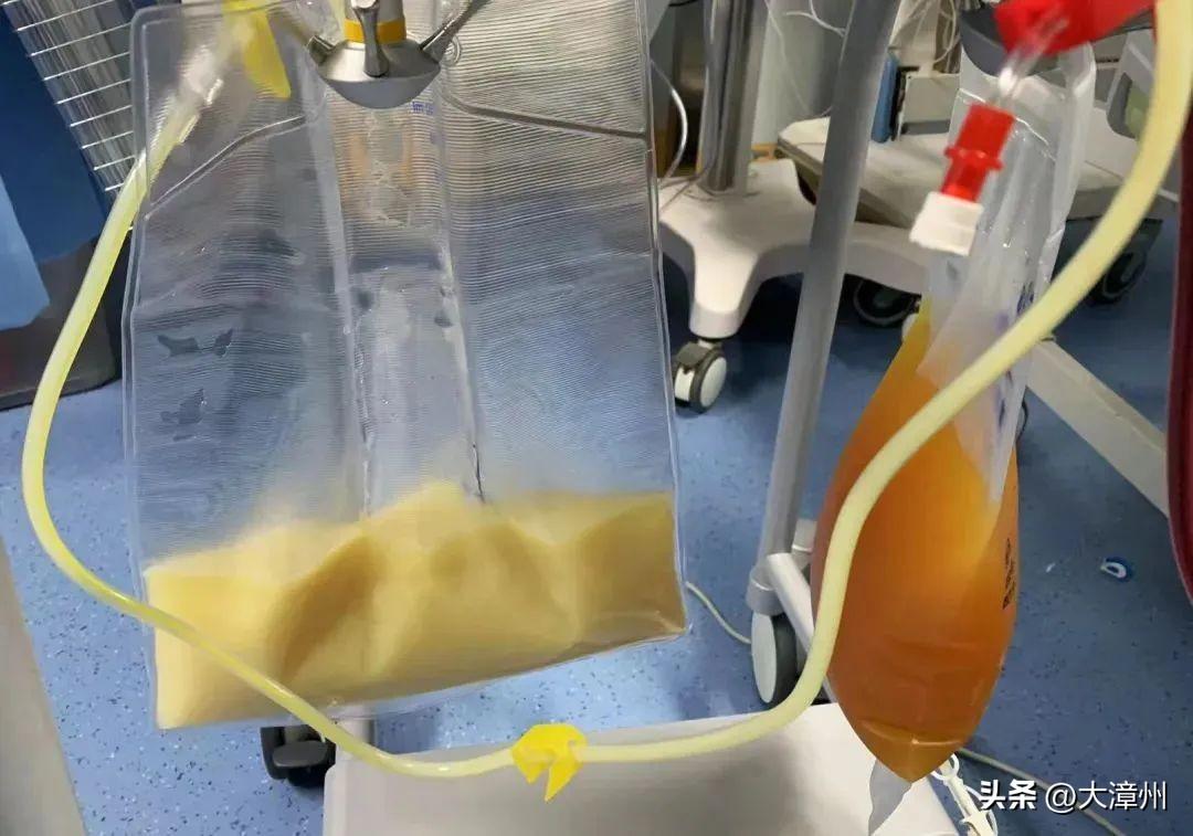 由于郑女士的血液里含有很高的脂肪成分,所以置换出的血浆就像"猪油色