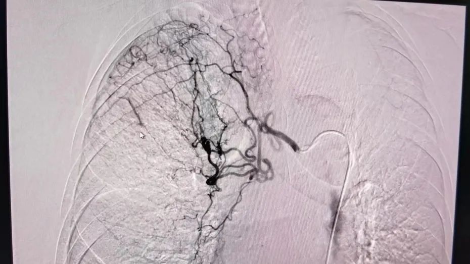 寶山區中西醫結合醫院成功進行首例支氣管動脈造影及栓塞術
