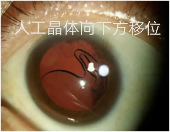 新技术新项目如何拯救脱位人工晶体