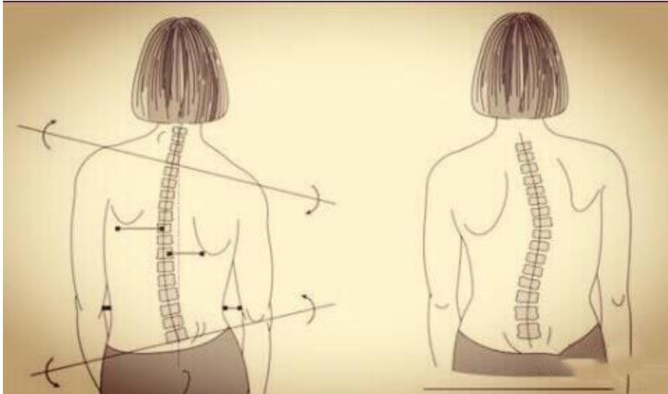 拒绝侧弯让中国孩子的脊背挺起来