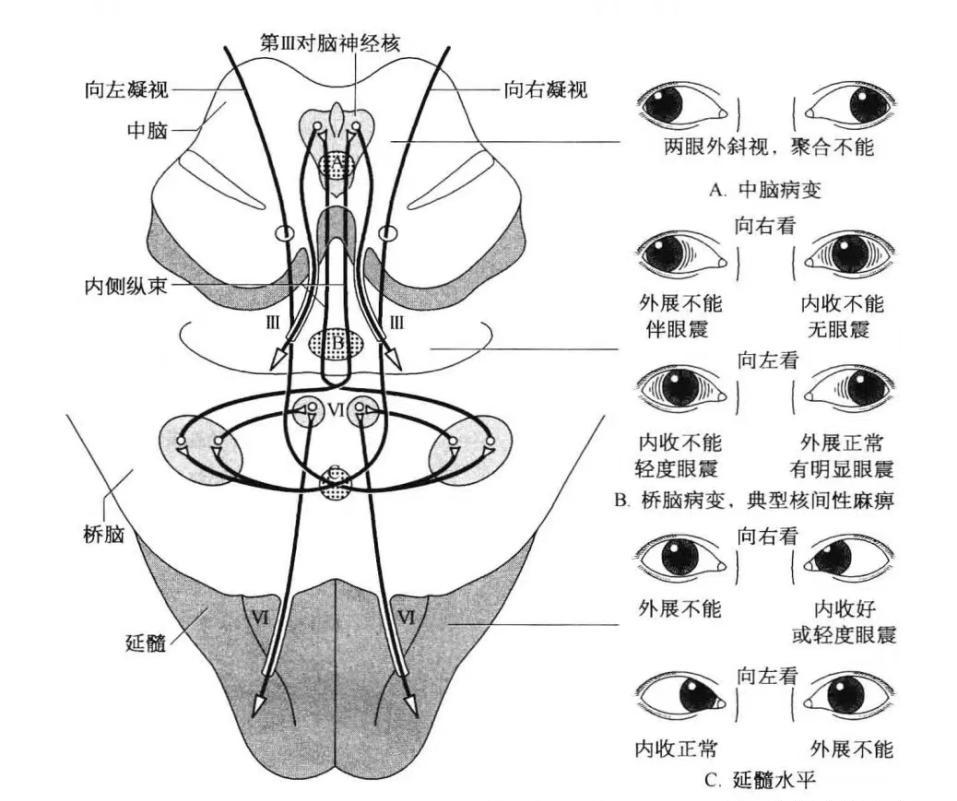 周围性眼肌麻痹、核性眼肌麻痹……一文掌握6种眼肌麻痹