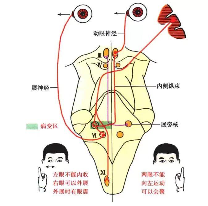 双眼对侧偏盲图解图片