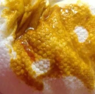 若是大便带有新鲜血液或者血丝,需要排查孩子是否肛裂出血.