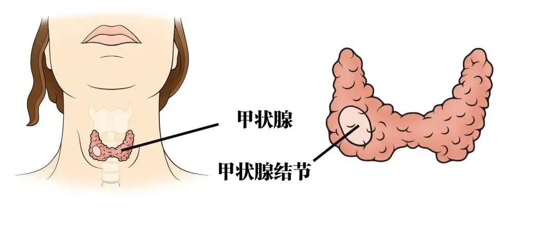 健康速递微创热消融让甲状腺结节患者免受开刀之苦