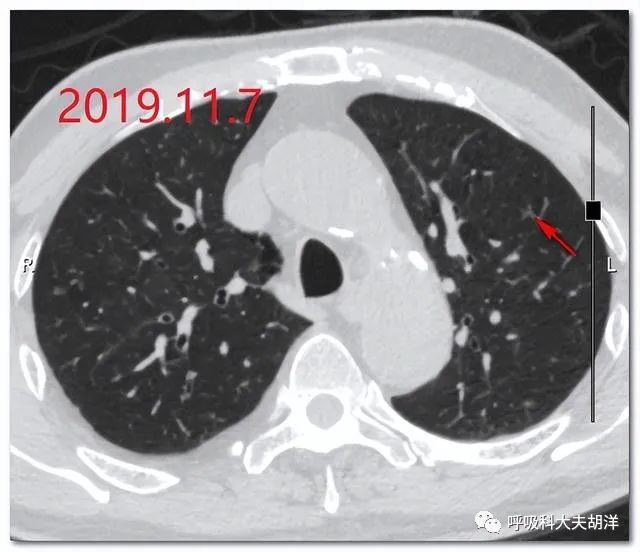 仅仅一年没做ct肺上就长出了一个带空泡的结节手术证实是恶性