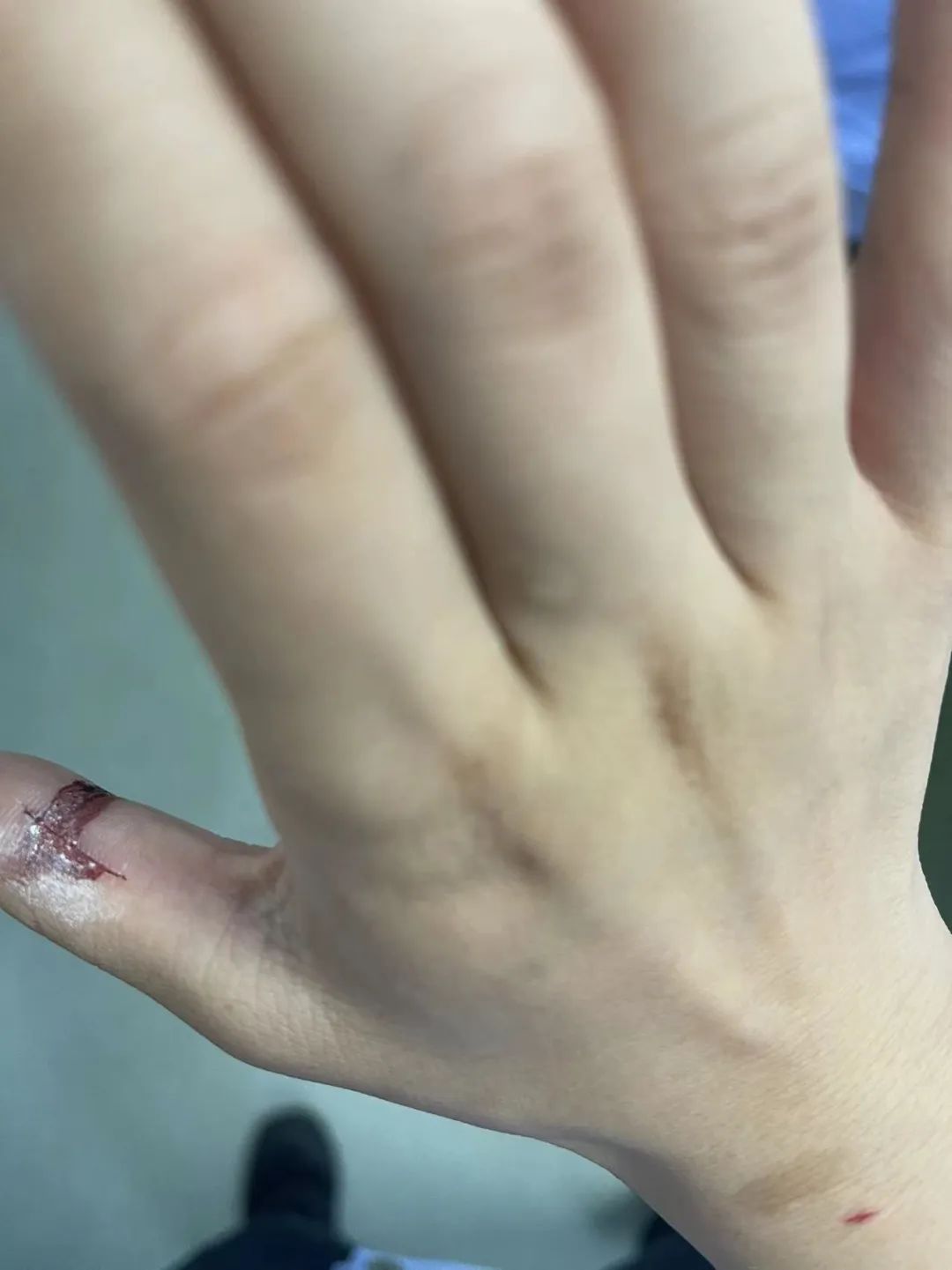 手指被门夹伤后的康复过程记录 - 知乎