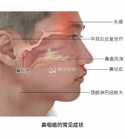 别把癌症当鼻炎,爱吃这类食物的人,尤其要警惕