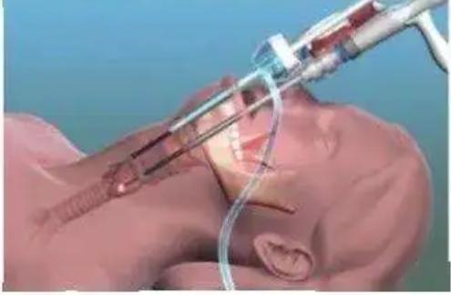 一般在表面麻醉下进行气管插管,保持呼吸道通畅后再施行手术