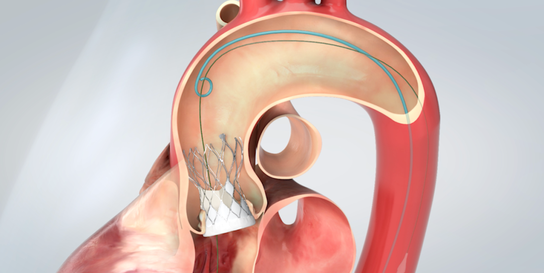 4小时修复3颗心，高难度经导管主动脉瓣置换术破解医学难题(图2)