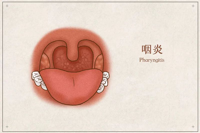 喉咙痛喝凉茶？小心越喝越严重！虚火怎么灭有讲究→(图2)